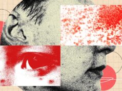 You Should Be More Freaked Out by Shingles