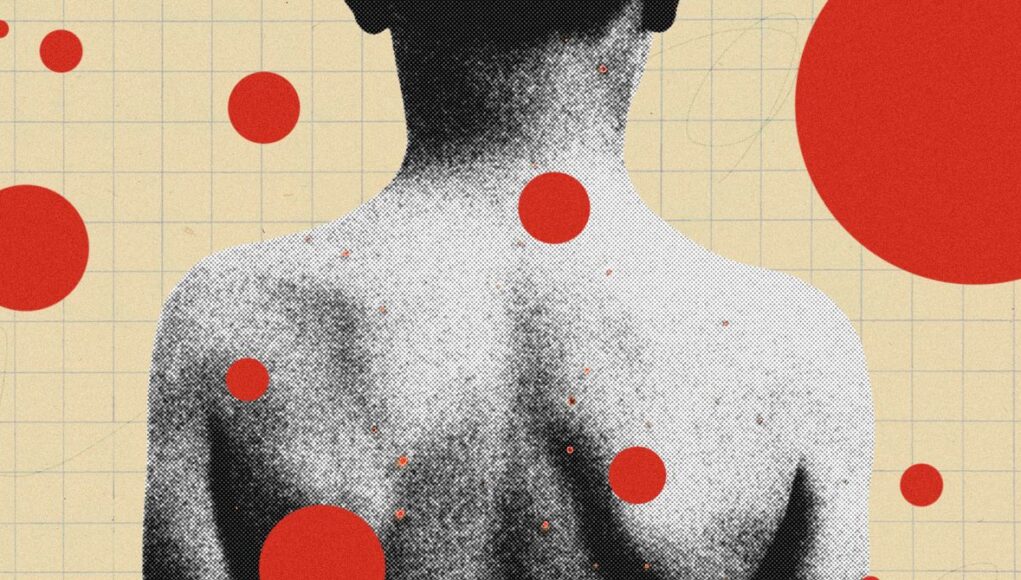 Shingles-Series-Chickenpox-Parties-Science.jpg